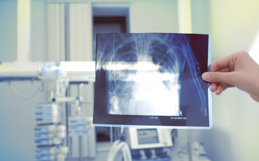 You could be at risk of silicosis